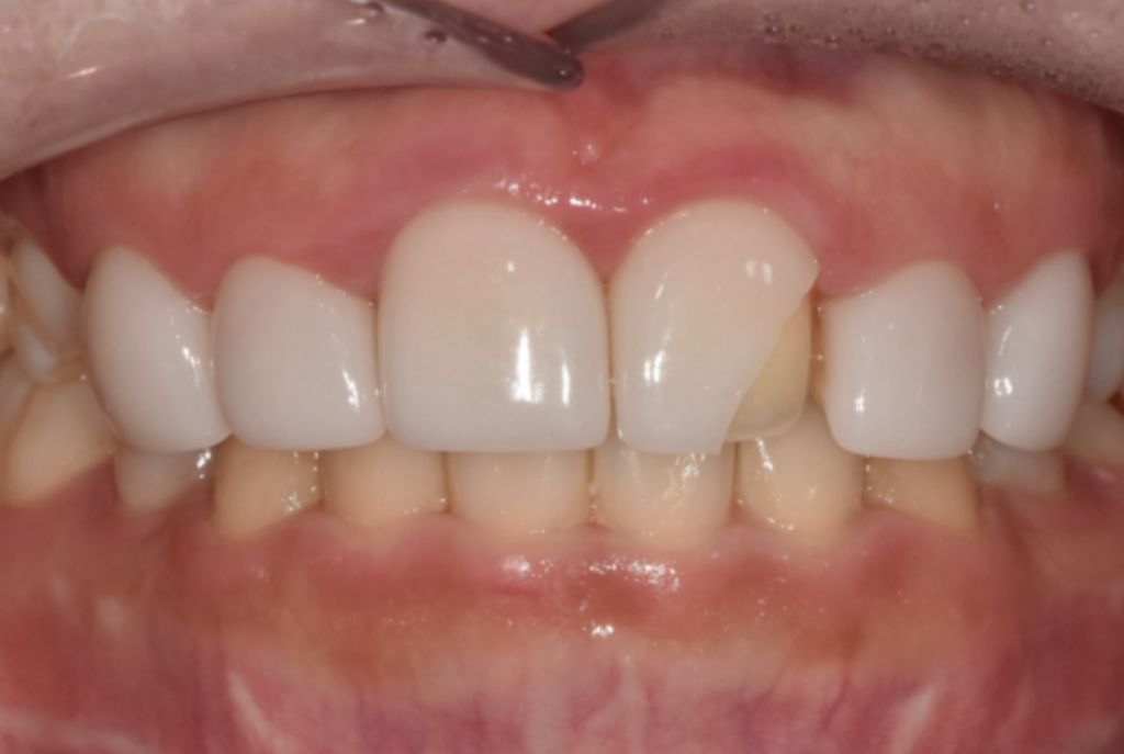 앞니 라미네이트 재시술