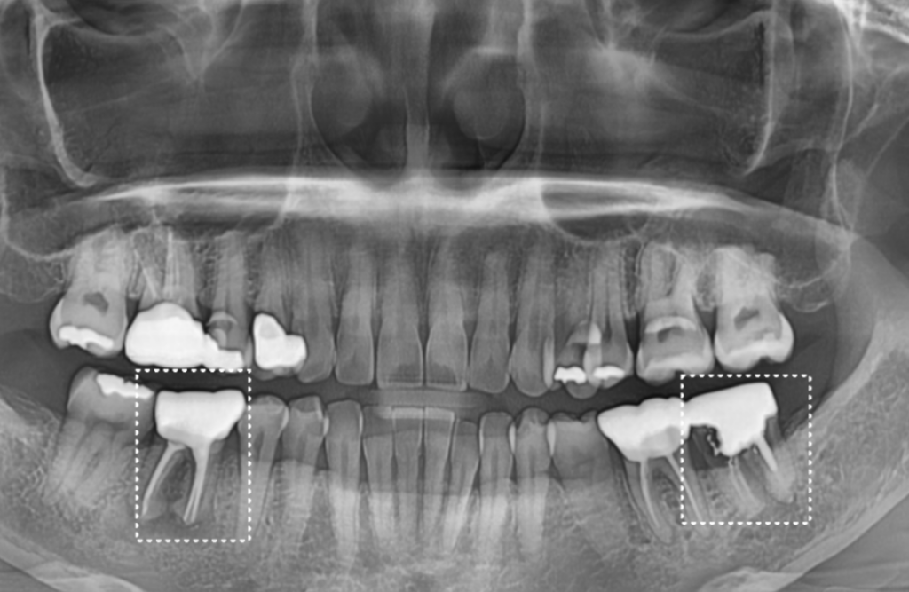 임플란트 뼈이식