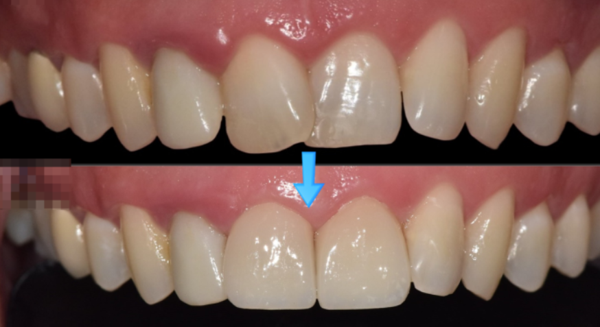 상일동 라미네이트 올바른 치료 사례: 과도한 삭제 없이 진행한 전후 비교