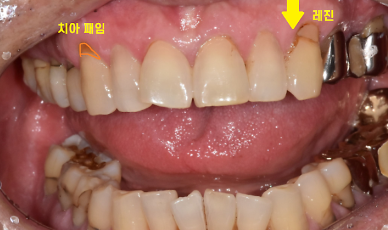 치아 목 부분 마모증 레진 치료 전후 비교 사례