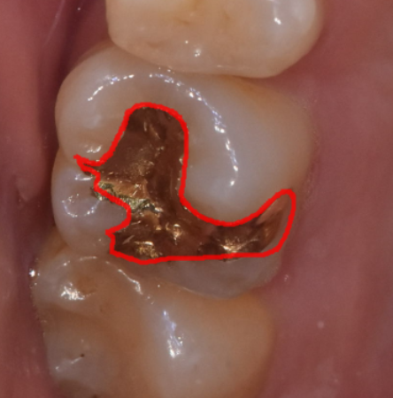 강동구 치과 서울바르디치과 어금니 골드 인레이 충치 치료