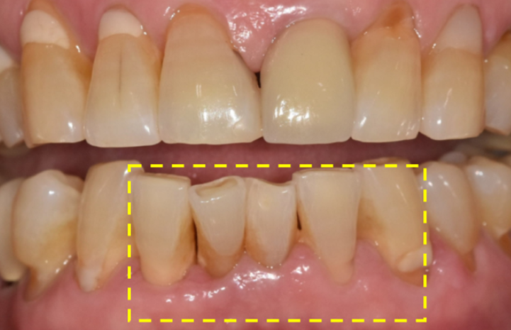 바르디치과 아래 앞니 흔들림과 치석으로 인한 잇몸뼈 소실 진단