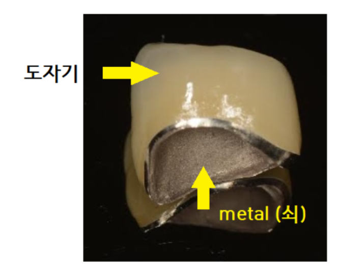 보험 임플란트 PFM 보철 내부 금속 및 심미적 단점 시각 자료