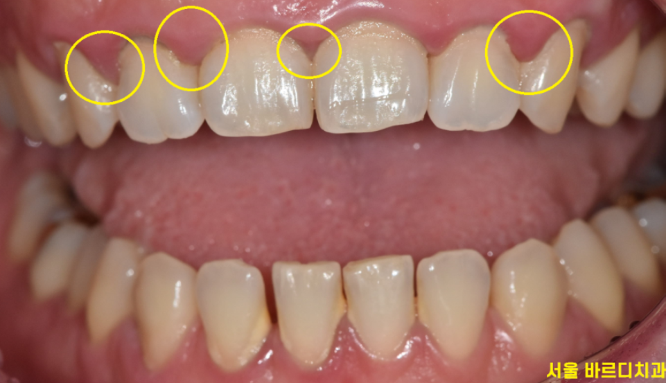 호르몬 변화로 인해 잇몸이 붉게 부은 임신성 치은염 증상