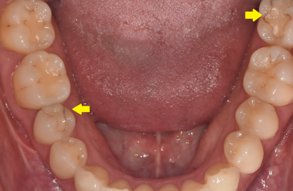 하이브리드 인레이 보철물의 미세한 변색 및 자연 치아 마모도 시각 자료