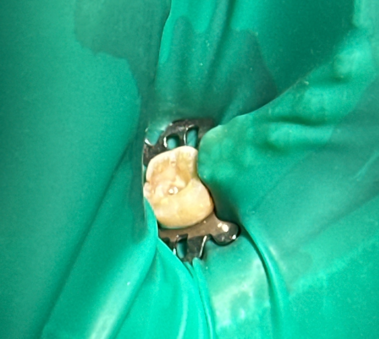 신경치료 치아만 격리하여 러버댐 설치한 모습