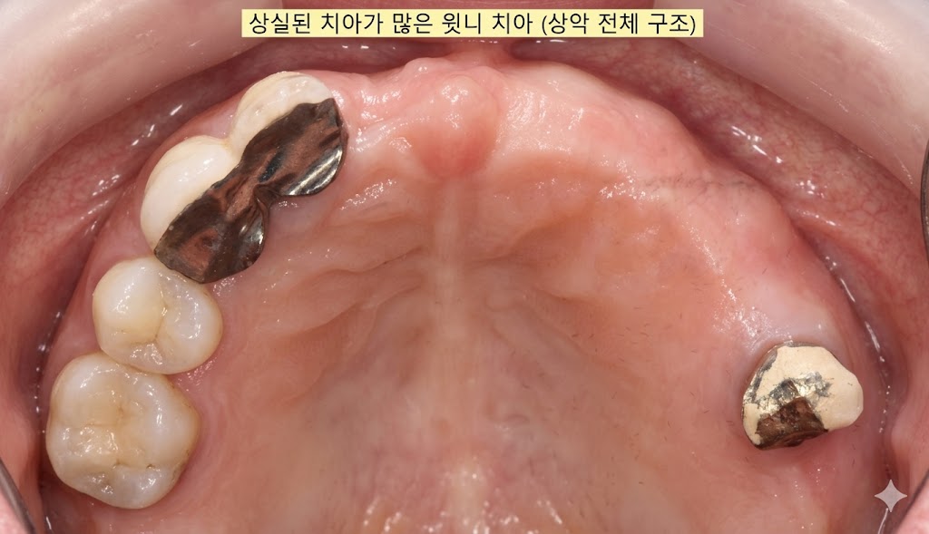 상일동 치과 틀니 사용 중 교합 붕괴로 인한 입술 씹힘 진단