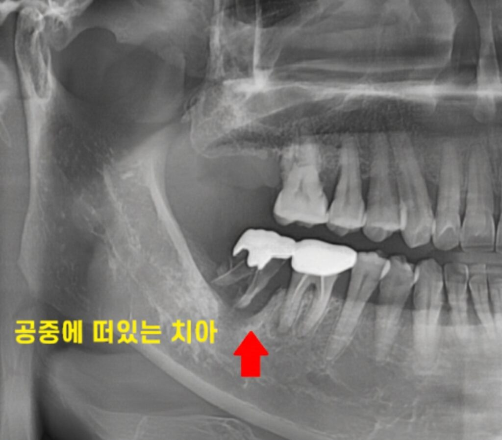 상일동역 치과 만성 치주염으로 인해 잇몸뼈가 녹아내려 이 흔들림 증상이 발생한 치아의 디지털 엑스레이 진단 이미지