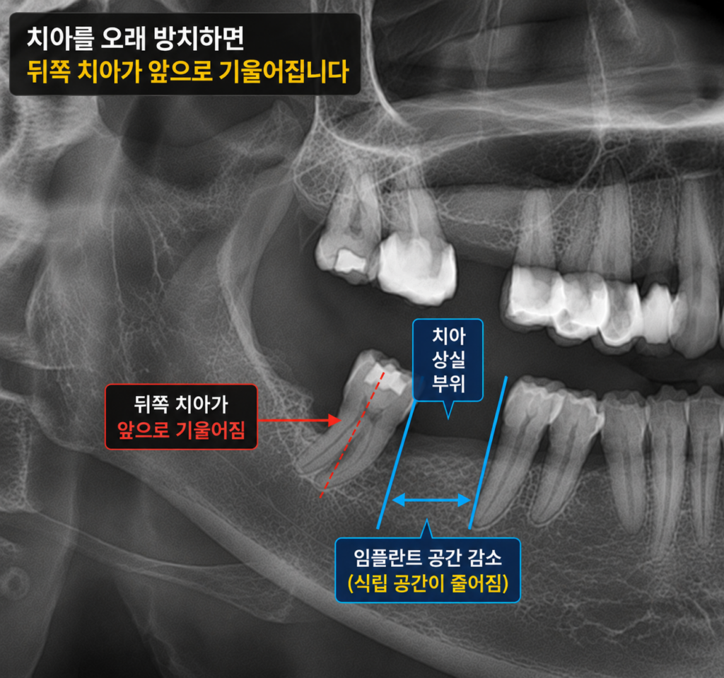 상실된 어금니로 인해 비어있는 구강 공간을 보여주는 디지털 엑스레이 이미지. 기울어지기 시작한 인접 치아들이 관찰됨.